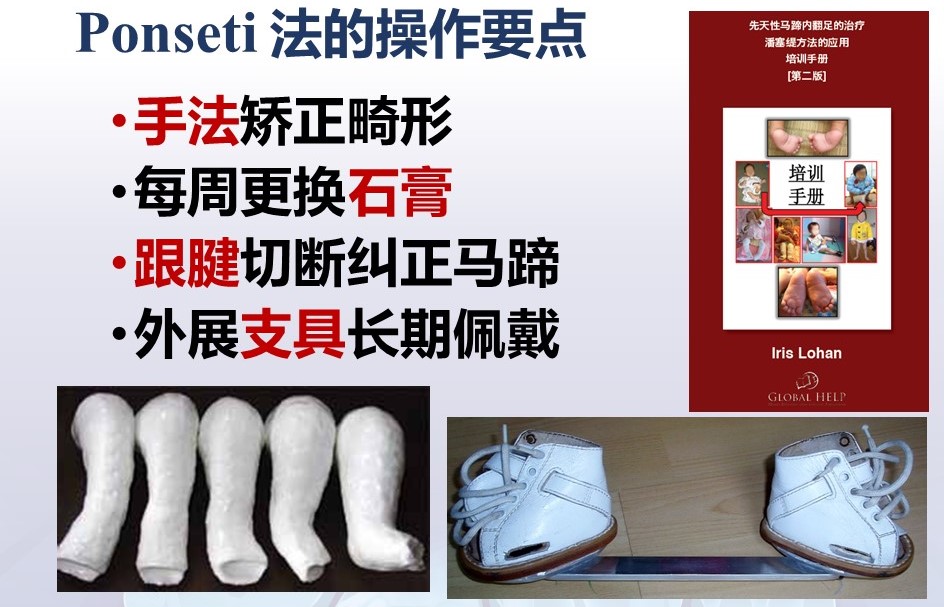 先天性马蹄内翻足患儿穿戴矫形鞋要求及注意事项