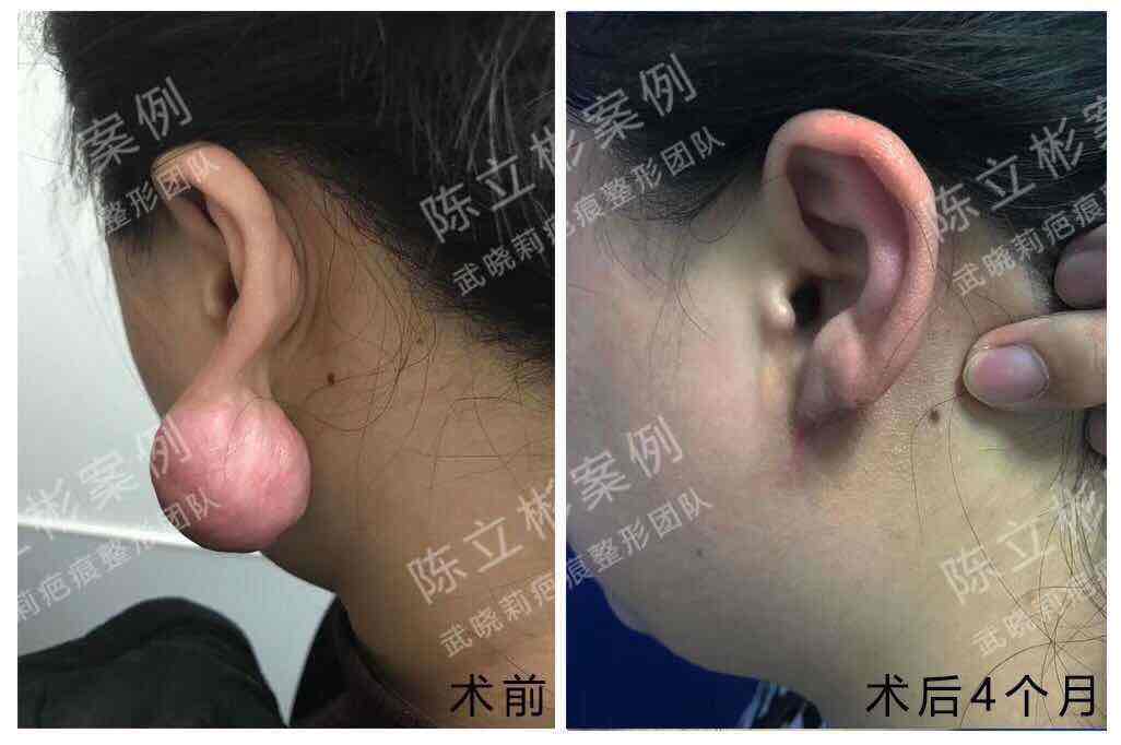 女性,27岁,今年2月局麻下行#双耳耳垂疤痕疙瘩# 切除 ,术后配合放疗