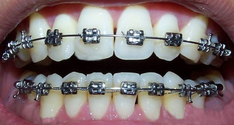 牙齿不好看咋办沈阳牙齿矫正