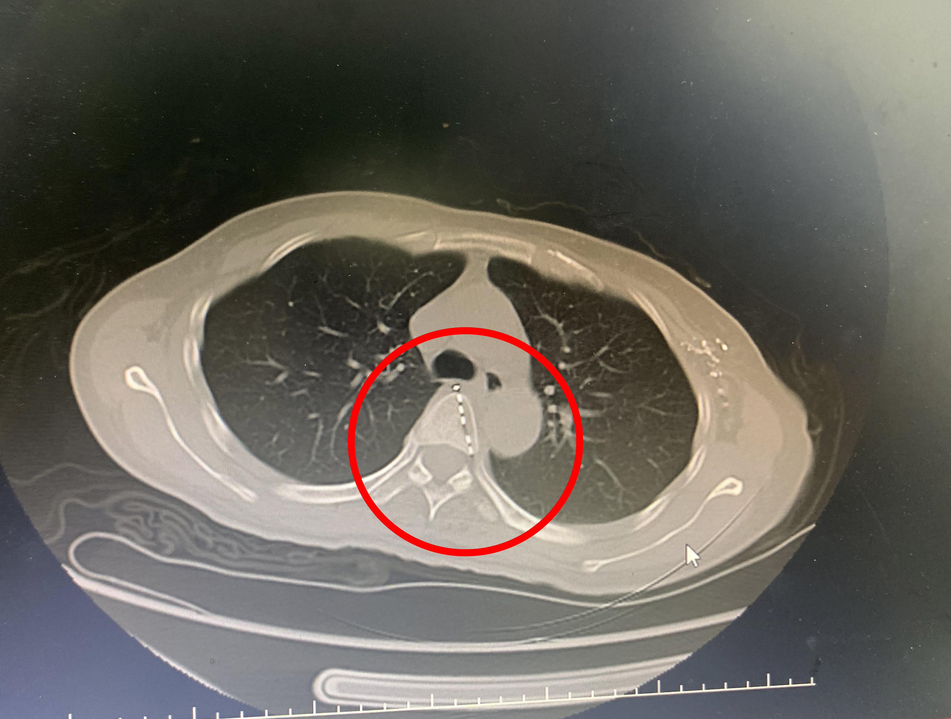 乳腺癌晚期并多发性骨转移,是这里给了我第二次生命