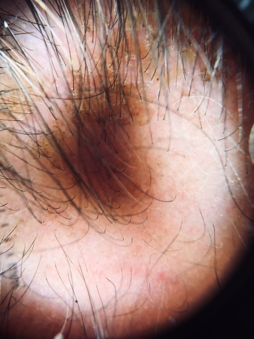 皮肤镜的狼疮发