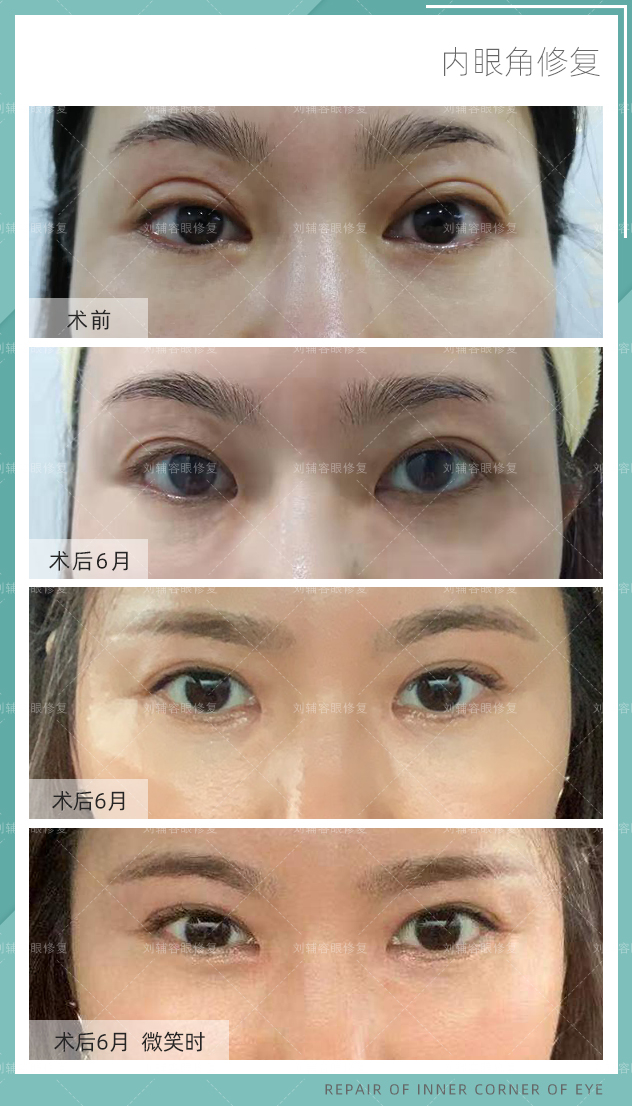 内眼角修复包回内眦赘皮