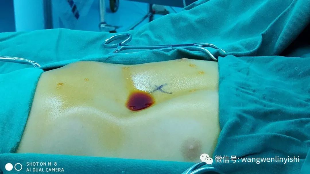 肋弓局部缺失合并漏斗胸的wang手术