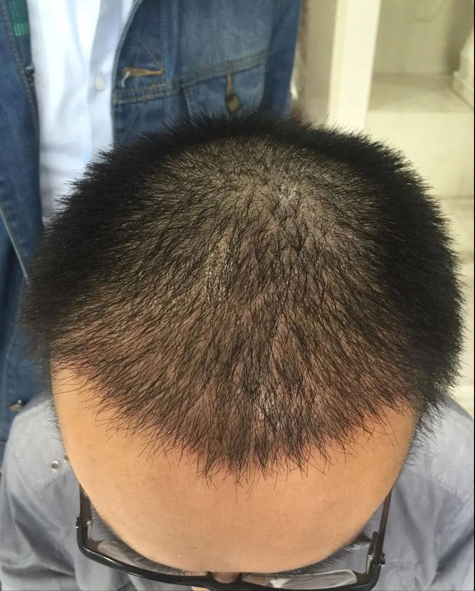 脱发10年严重稀疏光裸,仅一年时间已救回大半!