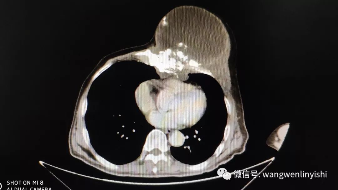 50年巨大胸壁肿瘤今天被切除