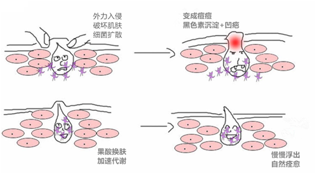 果酸化学剥脱治鸡皮肤价格(果酸化学剥脱术可以去鸡皮疙瘩吗)