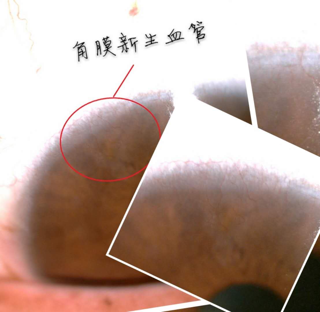 视疲劳引起的症状,再查裂隙灯,发现左眼角膜上缘新生血管长入角膜