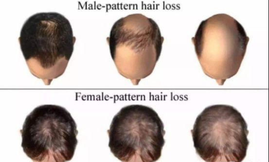 现实情况中,最常见的雄激素脱发是什么样的呢? m型 头顶稀疏