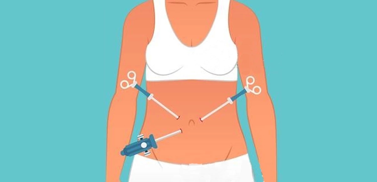 宫腔镜进入宫腔,不需要在腹部打眼,只需要应用膨宫介质扩张宫腔就可以