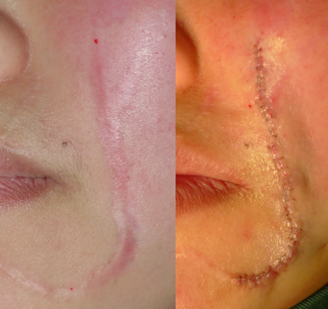 脸部植皮手术后恢复图图片