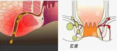 马蹄形肛瘘图片图解图片