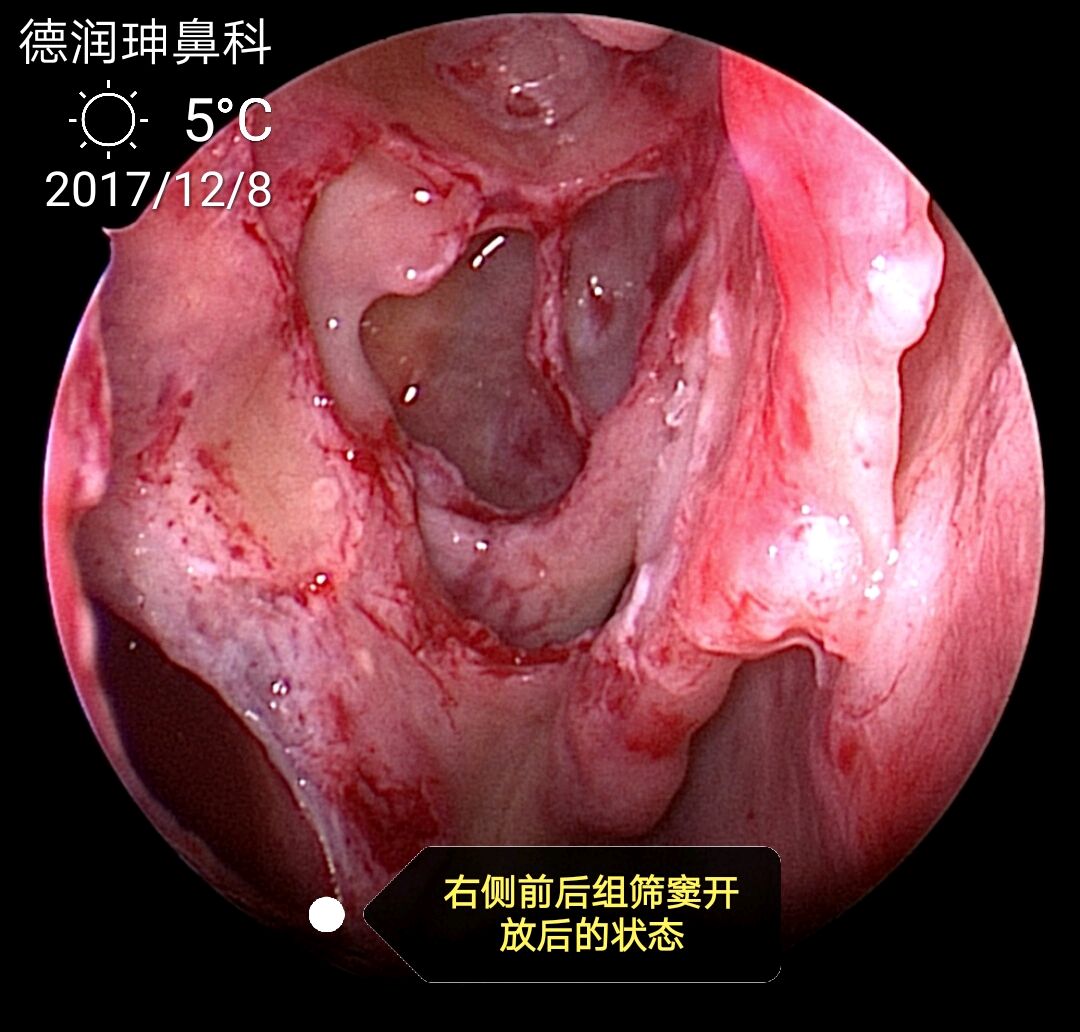 这位慢性鼻鼻窦炎鼻息肉患者是丰台区的社区卫生服务中心全科医生的