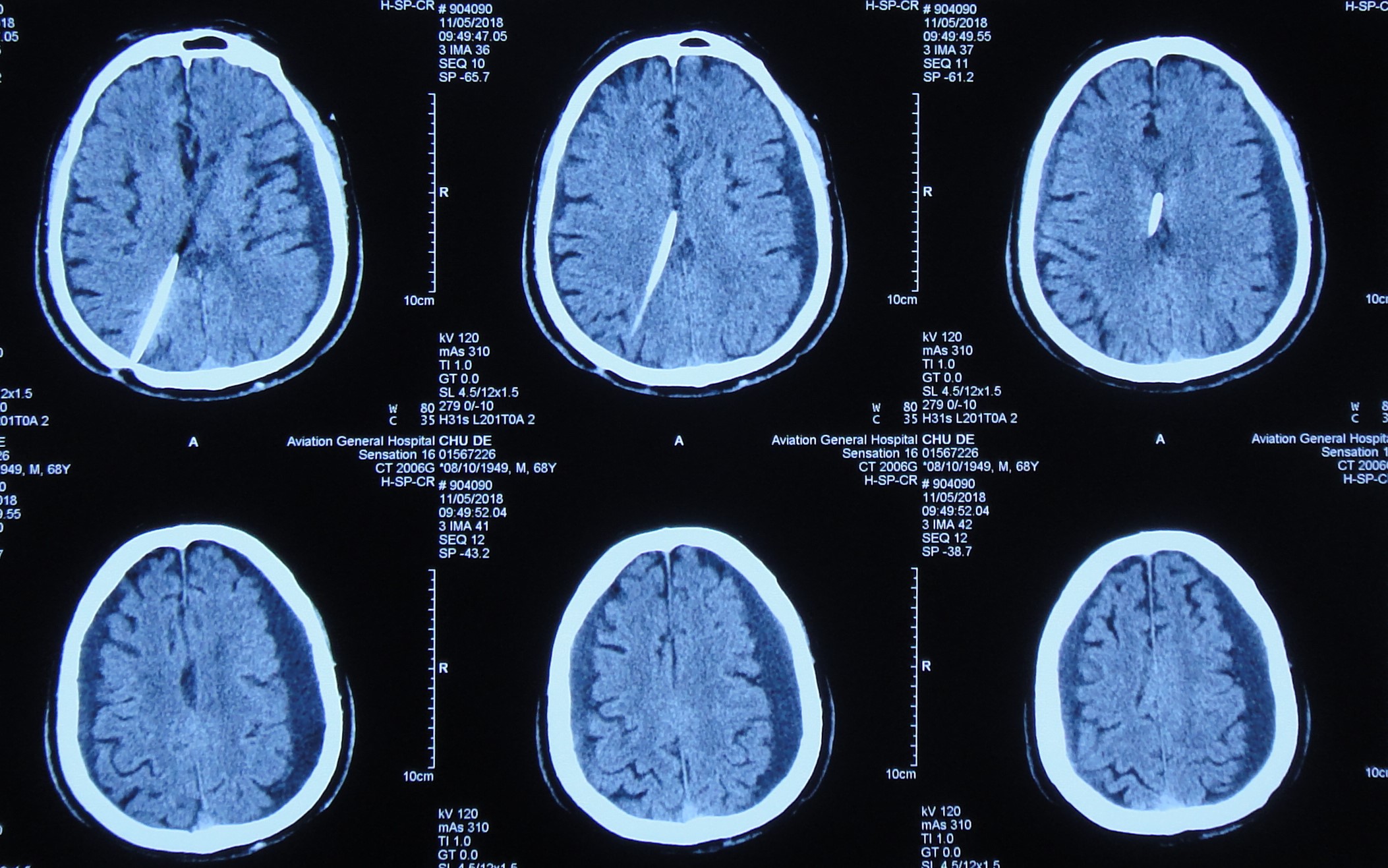 脑脊液科治愈具有痴呆和生活自理能力减退等表现的老年正常压