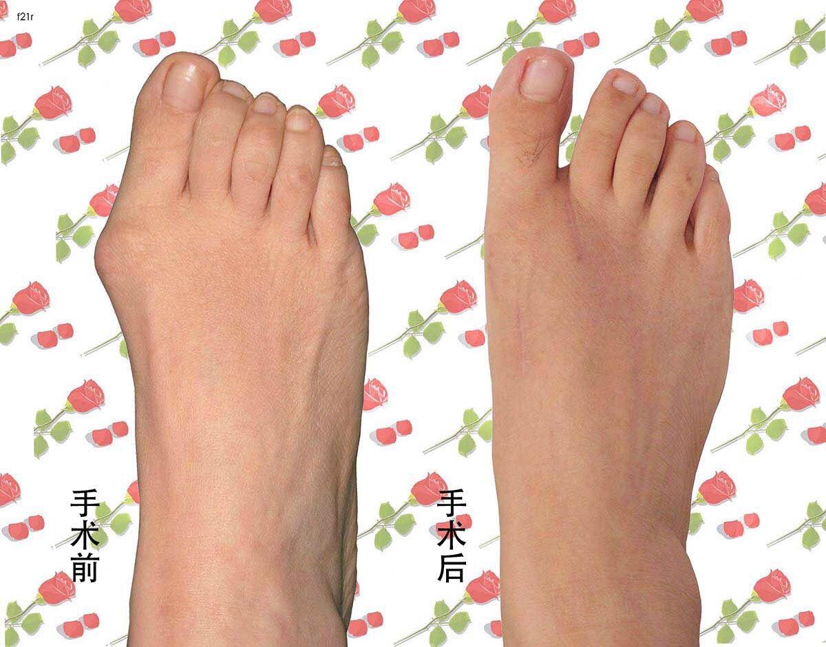 3,没事的时候可以多活动脚趾,在家里可以经常练习脚趾抓毛巾, 对拇