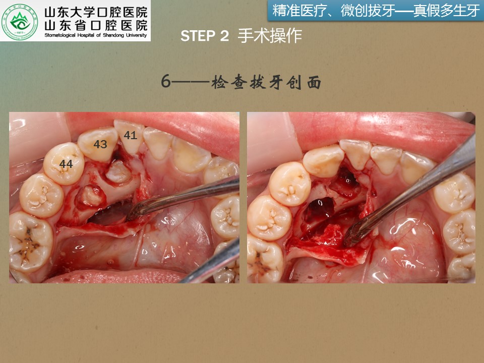 多生牙拔除手术步骤图片