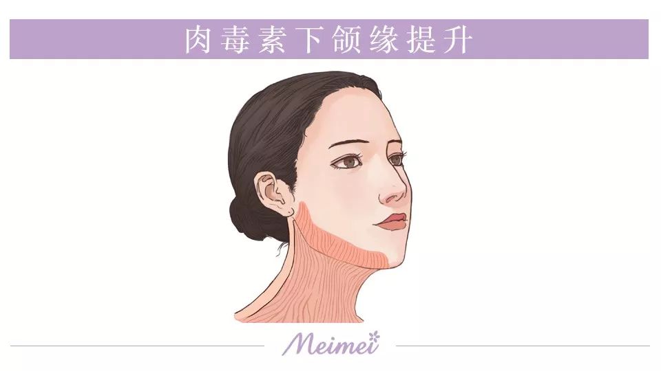 用肉毒素把颈阔肌的下拉的肌肉力量减弱,就起到了提升的作用.