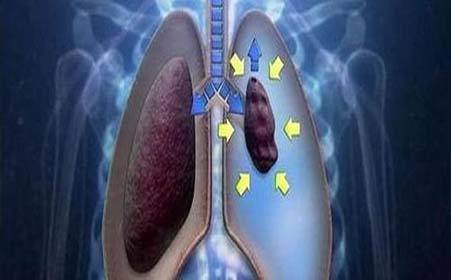 碰到气胸,怎么办?