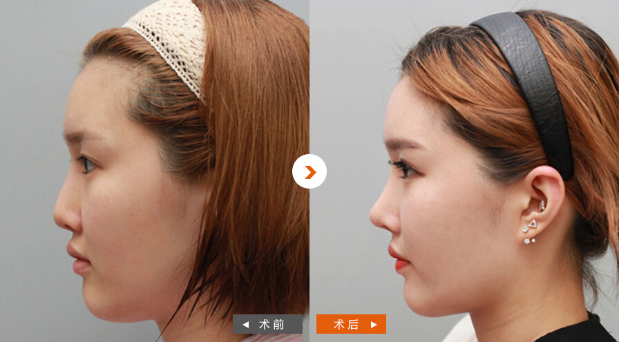 5,鼻部皮肤很薄的患者也可以进行膨体隆鼻手术.