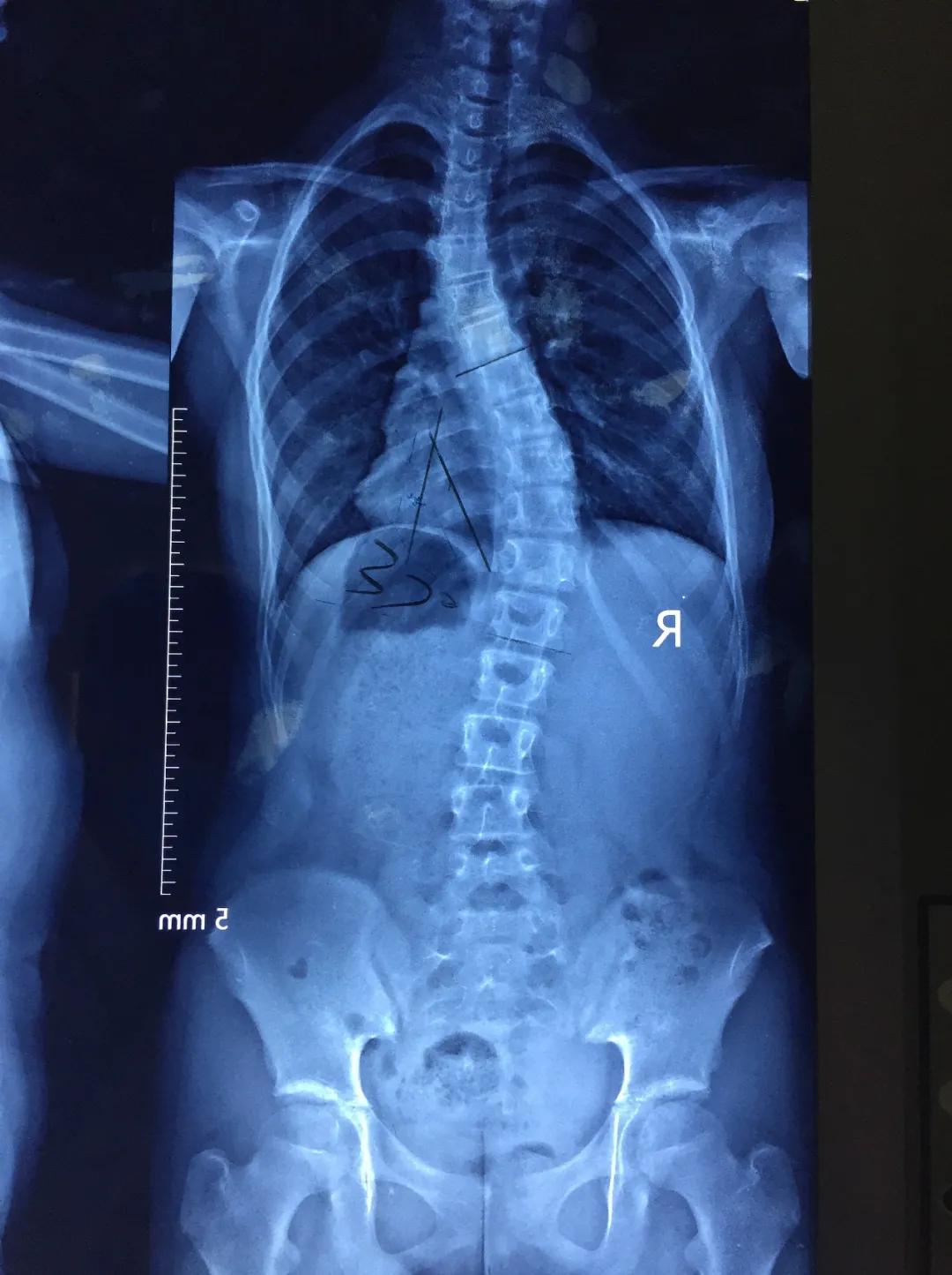 12岁女孩脊柱侧弯,惠人 大兴联合实施全脊柱矫形术