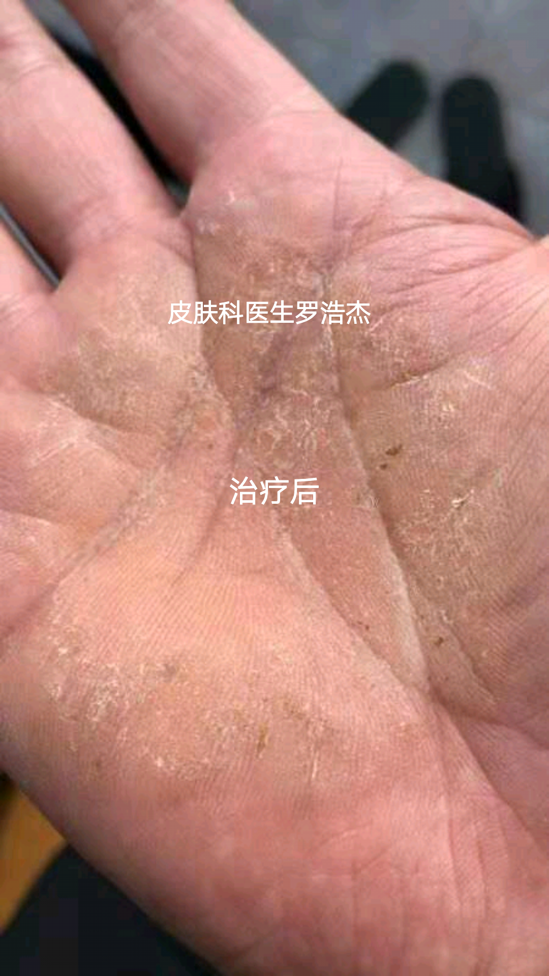 手部慢性溼疹