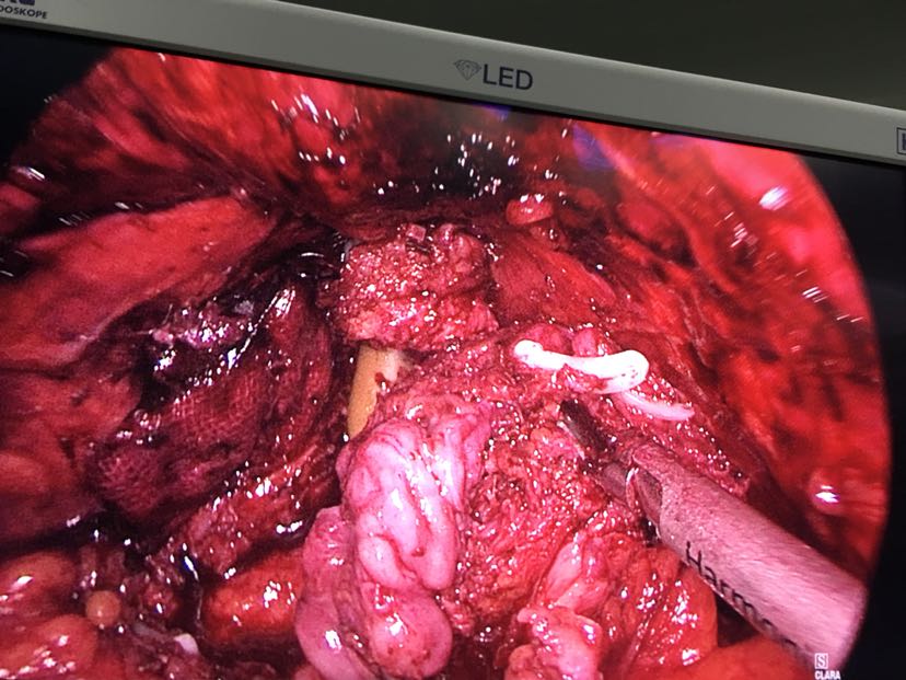 全腹腔镜前列腺癌根治术