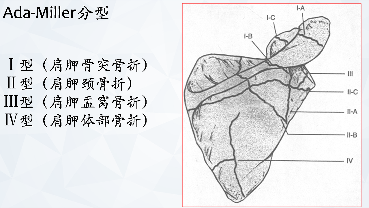 涨知识肩胛骨骨折分型