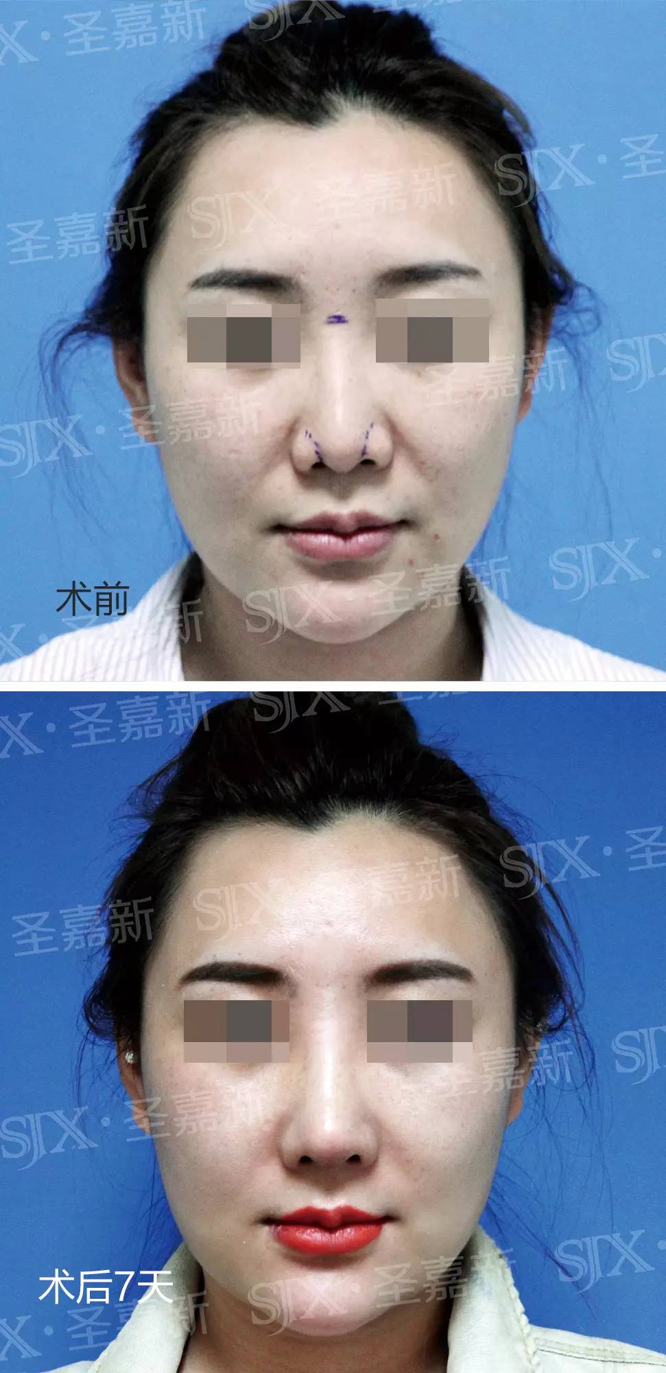 每个人脸型,五官形态不同,隆鼻就和穿衣一样,适合自己的才是最好的.