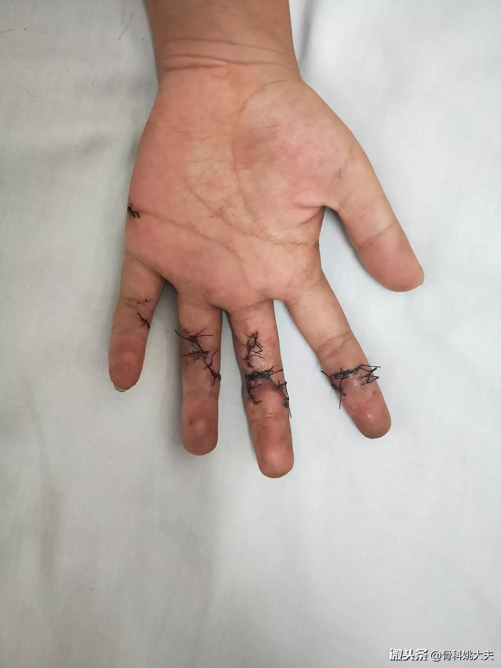 调皮的小乐把手给割破了差点手就废了