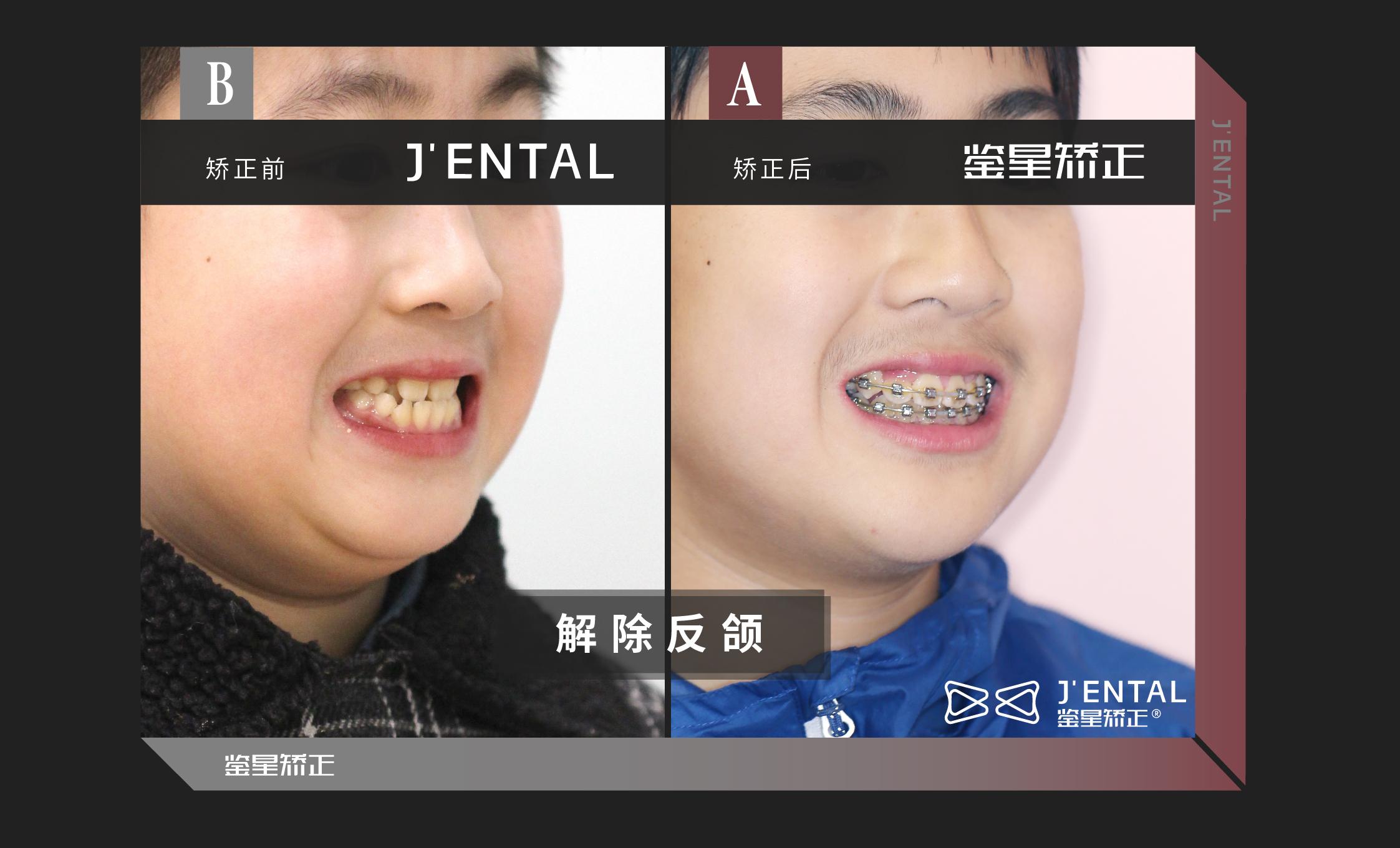 关于青少年牙齿矫正,听信这些谣言,你会错过最佳时机