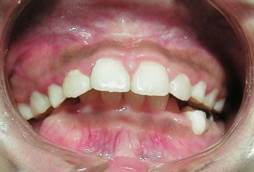 牙齿不齐及各类错颌畸形的危害?