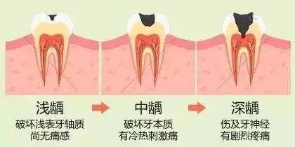 它可以繼發牙髓炎和根尖周炎,甚至能引起牙槽骨和頜骨炎症.