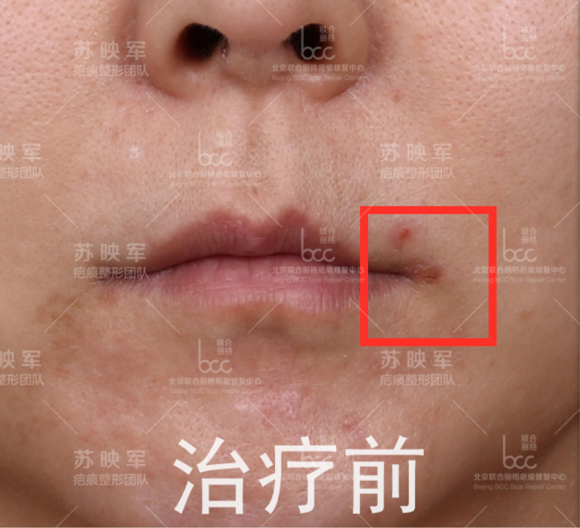 嘴角疤痕增生惹烦恼,非手术综合治疗重新绽放灿烂笑容
