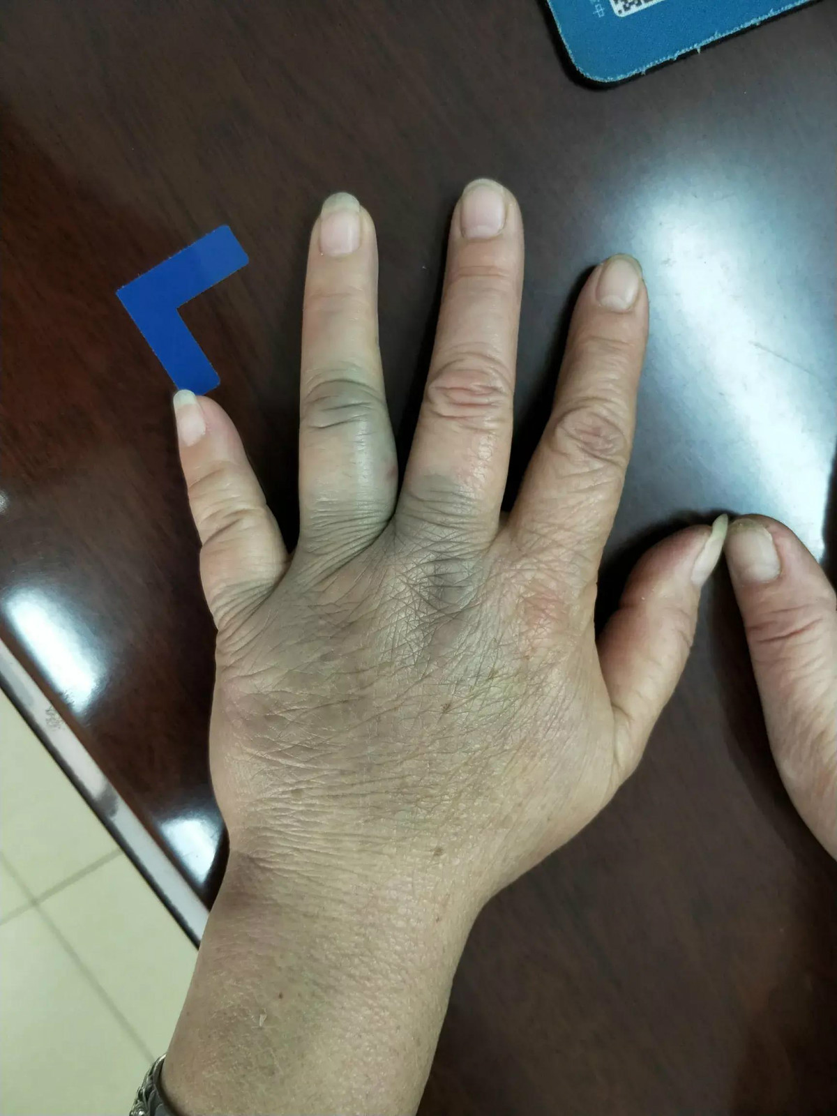 检查发现凝血功能异常是血液病吗掌握这四点轻松鉴别血液病