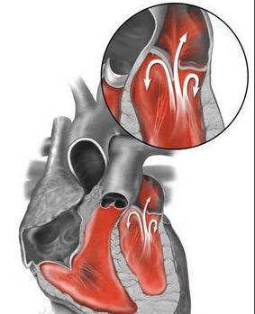患者問:二尖瓣輕度返流到底該不該治療?這幾個預防請你收藏!