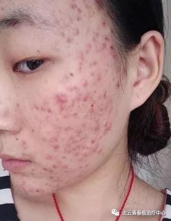青春痘是发生在毛囊皮脂腺的慢性皮肤病,发生的因素多种多样,但最直接