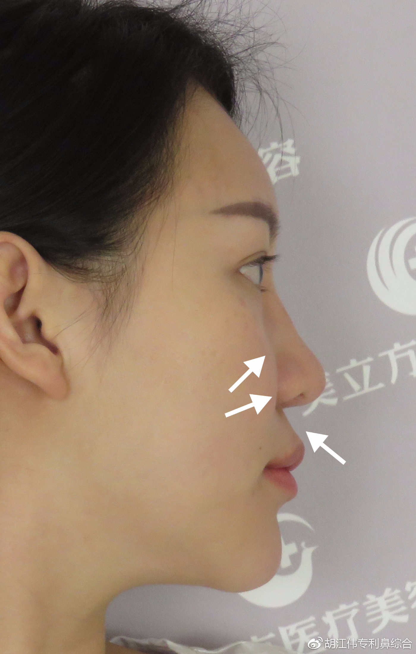 鼻基底凹陷和面中部凹陷的区别在哪里？ - 知乎