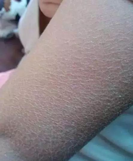 皮屑,裂纹这样的情况真的很让人心烦,每天都拼命洗澡,可是一洗完皮肤