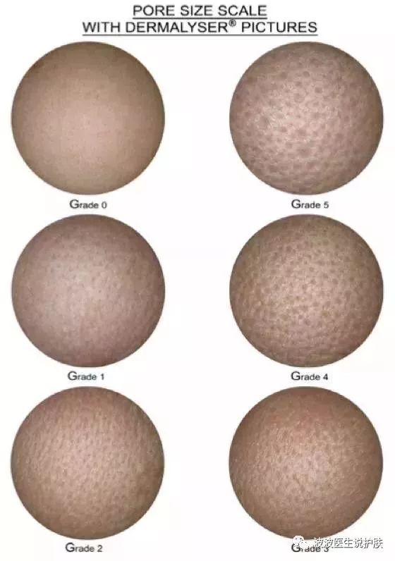 角质型毛孔粗大 毛孔现象:黑色或米白色的圆形孔状粉刺,有时会有粉刺