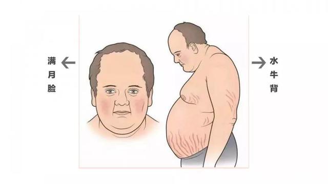 糖皮质激素治疗风湿病,可能股骨头坏死,怎么办?