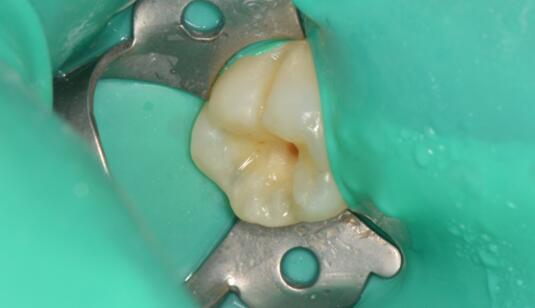 龋齿后牙树脂充填-陈栋副主任医师-爱问医生