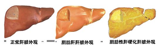 脂肪肝标本图片
