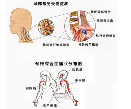 颈椎引起左胸痛位置图图片