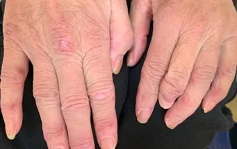 皮肌炎皮疹多久能消退?在外用药上有哪些选择?