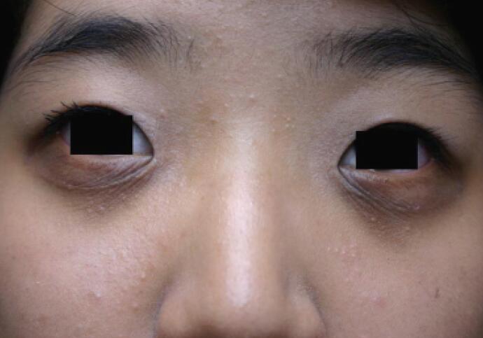 黑眼圈目前主要分为三种不同类型: 1, 色素沉着性:黑色素过度沉积引起