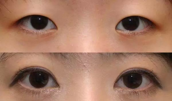 做双眼皮时,开不开眼角区别大吗?