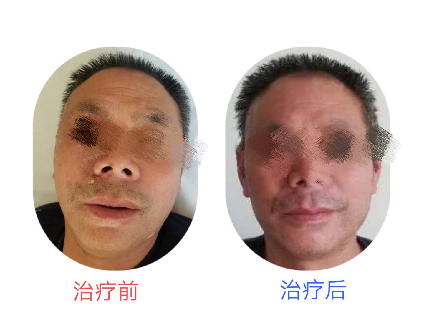 盤蛇瘡纏腰龍皮膚針刺樣疼痛帶狀皰疹應該如何治療