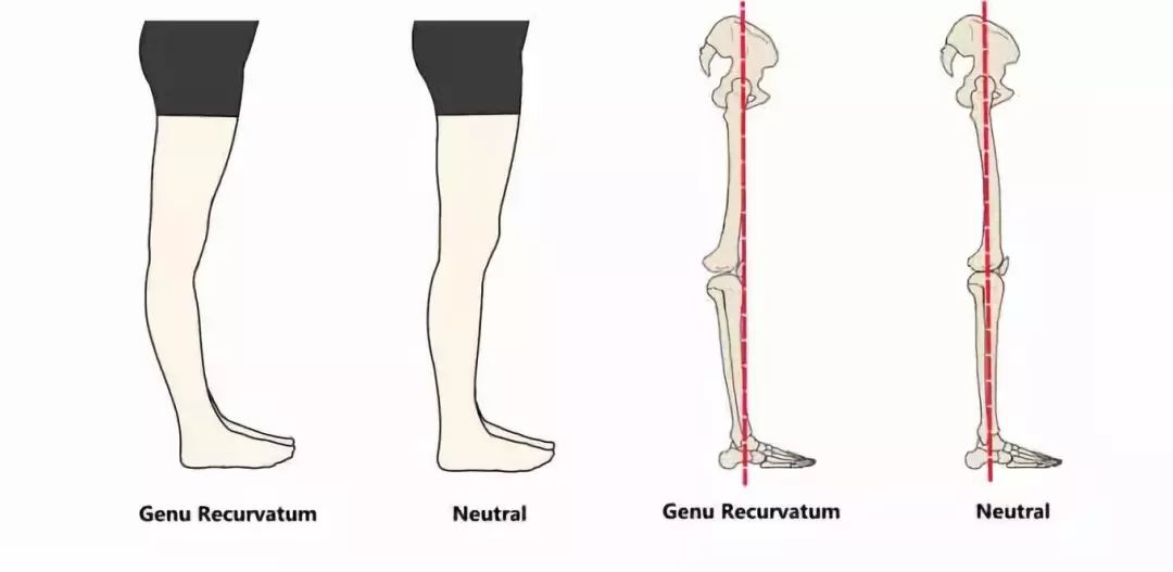 你是小腿粗,还是膝关节超伸了?
