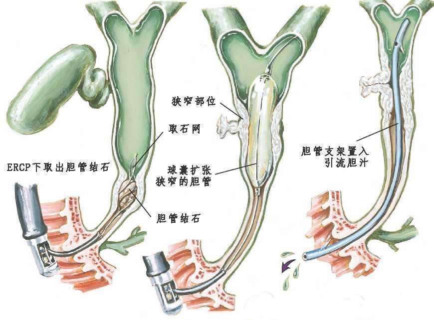 治疗胆道疾病的多面手——ercp est-闫涛副主任医师-爱问医生