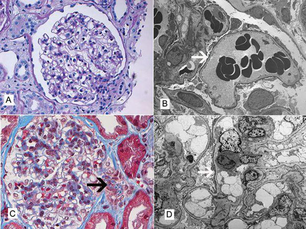 微小病变肾病如何预防康复后复发?