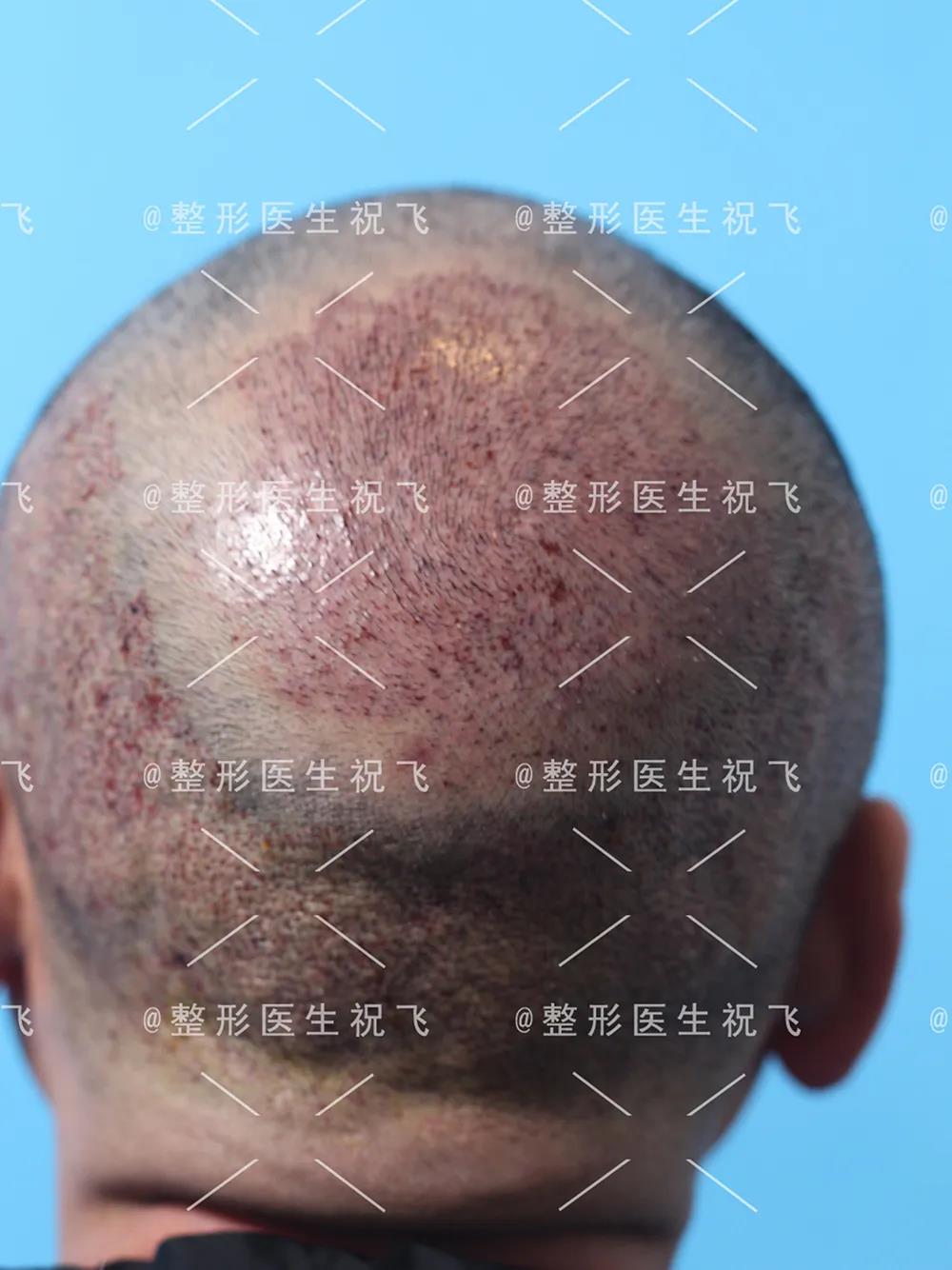 植发案例丨fue种植发际线 头顶加密